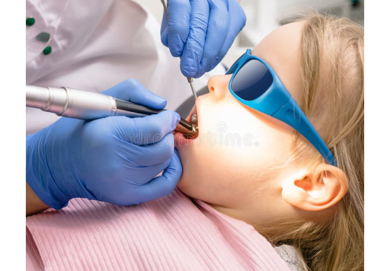 Understanding The Process: How Tooth Fillings Are Done?