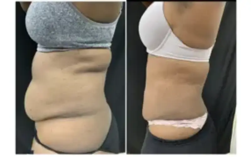 Revitalize Your Figure: Laser Liposuction Trends In Washington