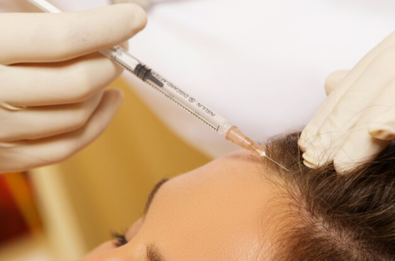 Microneedling Marvels: The Future Of Hair Loss Treatment