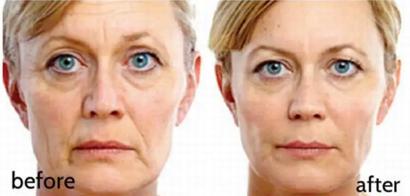 Unveiling The Wonders Of Juvederm In Washington DC
