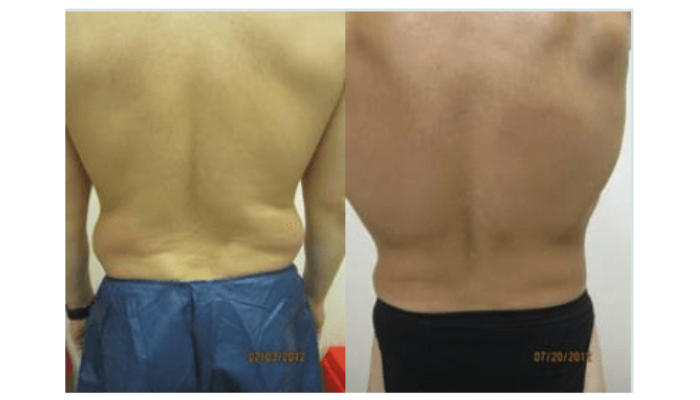 Top 5 Myths About Liposuction You Need To Stop Believing